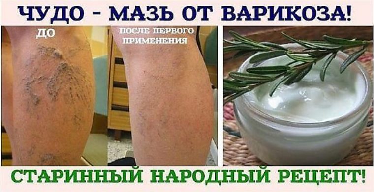 Чем лечит варикоз в домашних условиях